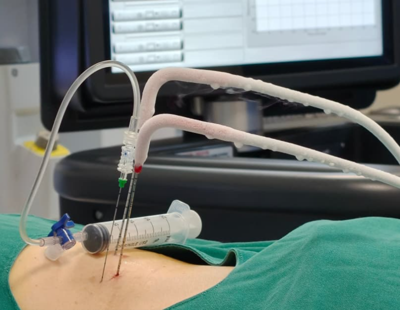 CRYOSURGICAL ABLATION